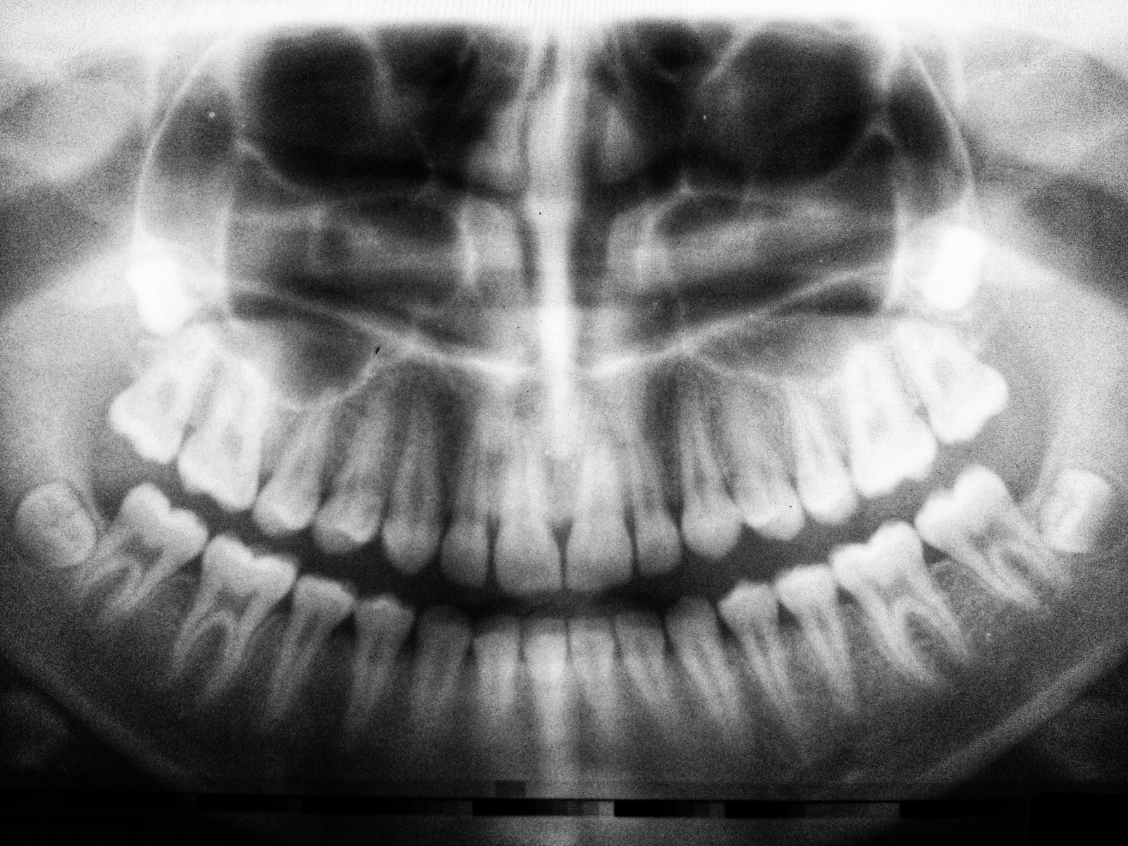 Dévitalisation Dentaire : Comment, Pourquoi et Coût de l’Intervention | Soulager la Douleur Dentaire