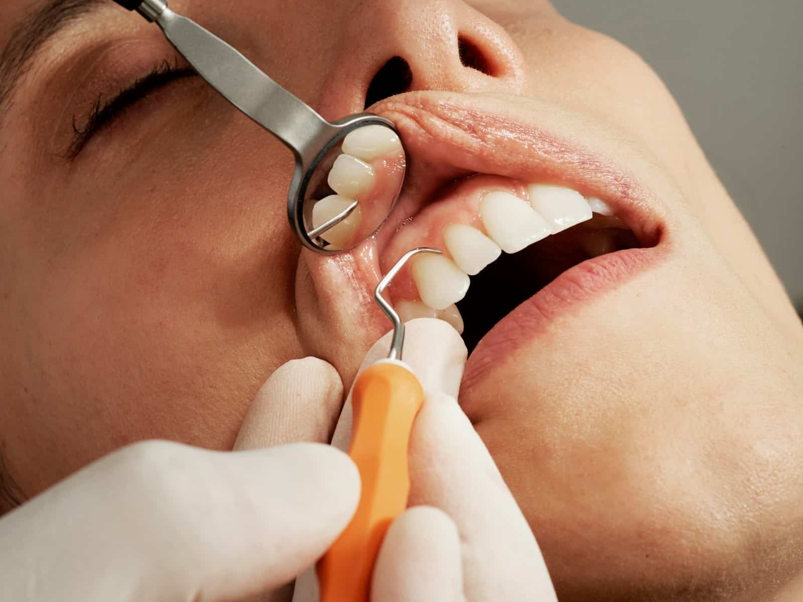 Comment prévenir et traiter les maladies des gencives : Guide complet pour des gencives saines
